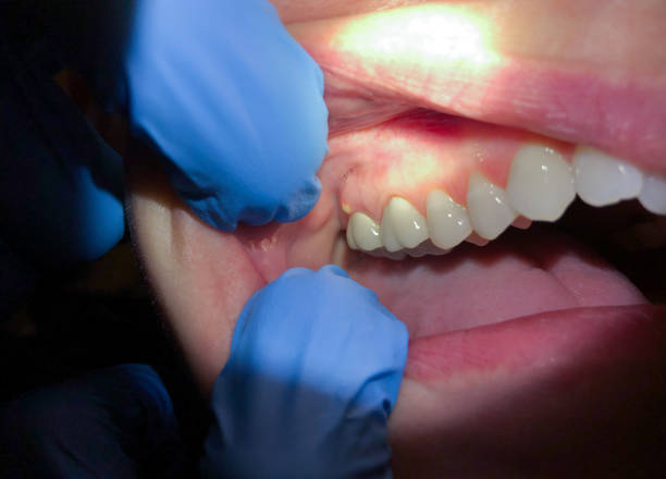Best Emergency Treatment for Dental Infections or Abscesses in Bradner, OH