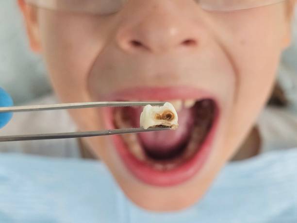 Best Emergency Tooth Extraction in Bradner, OH